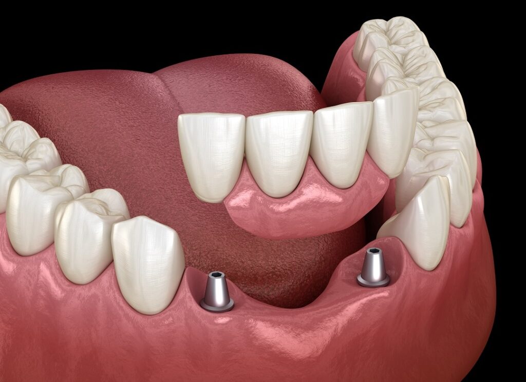 Dental Implants